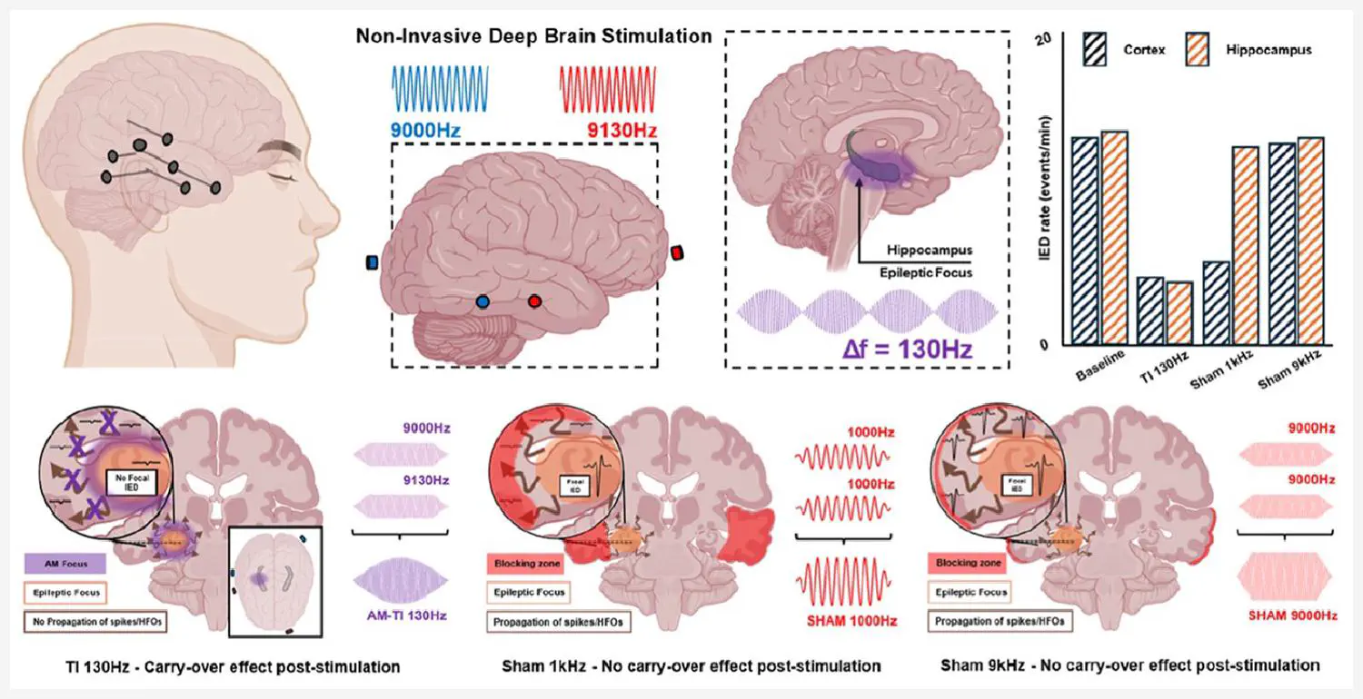 news-20251125-Missey-Brain-Stimulation.jpg